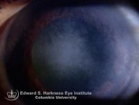 Central stromal scarring in a middle-aged woman with quiescent congenital syphilis